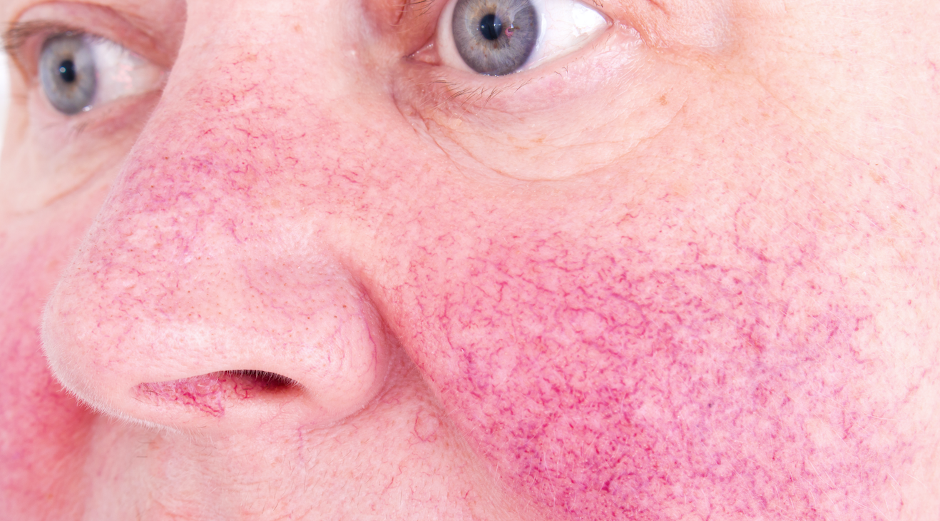 rosacea 